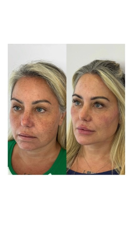 Caso do Protocolo 4 Lift, antes e depois