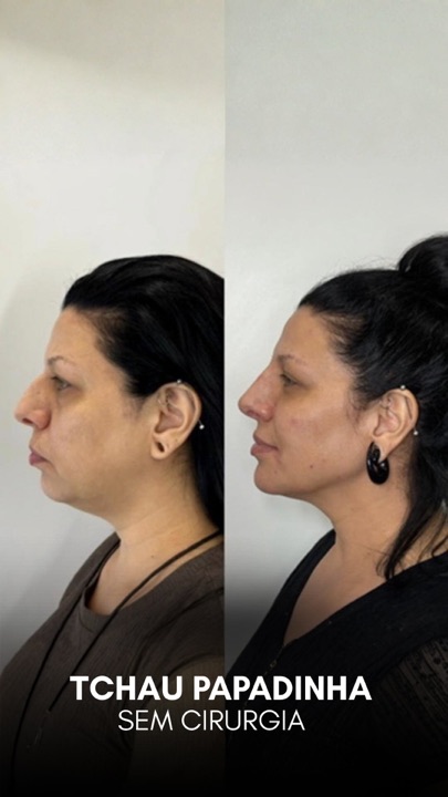 Caso de papada sem cirurgia